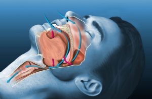 Sleep Apnea Treatment in NYC