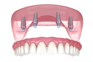 All-on-4 Dental Implants illustration