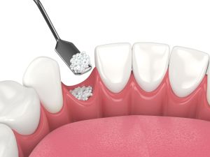 bone graft NYC
