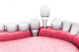 Ceramic Implants Midtown Manhattan